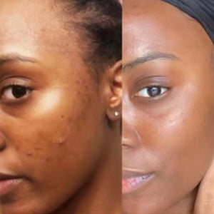 The Best Product Against Skin Imperfections: Reach Paris Cleansing and Exfoliating Pads with Turmeric and Kojic Acid, 3 in 1!”